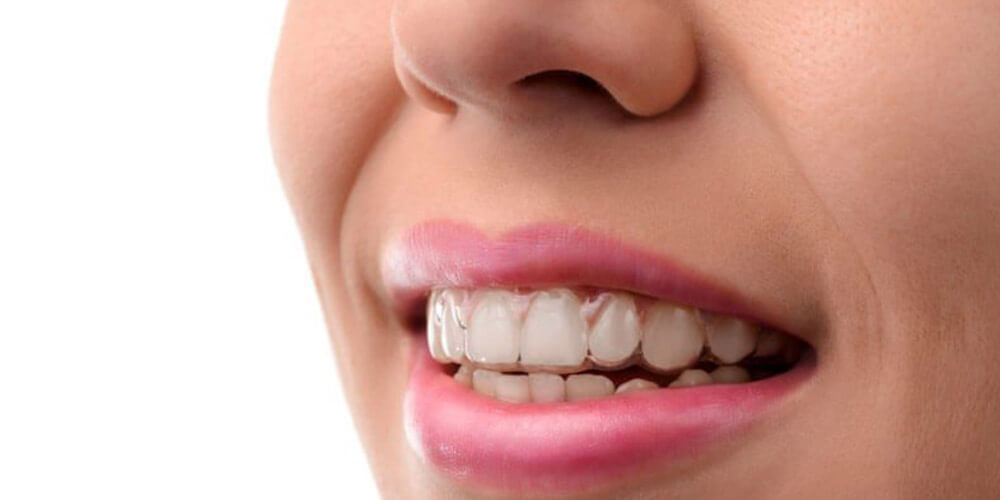 Invisalign Braces Treatment in Sayan